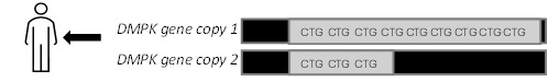 dm1 triplet repeat expansion image