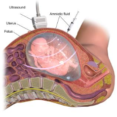 Amniocentesis